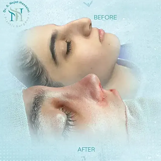 عمل بینی نیمه فانتزی