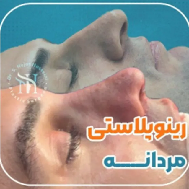 ریوپلاستی مردانه نمونه کار