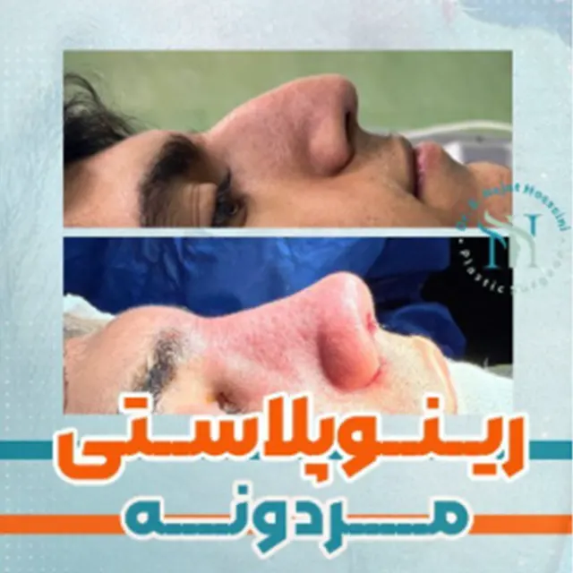 عمل بینی مردانه نمونه کار بهترین جراح