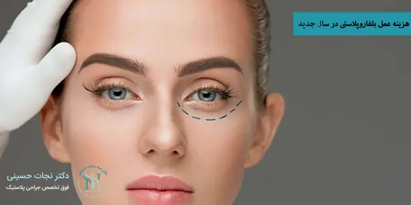 هزینه جراحی بلفاروپلاستی در سال جدید